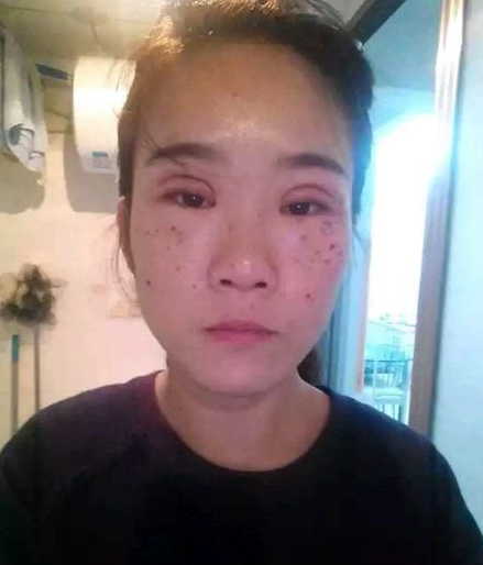 痘医生分享实战青春痘的经验