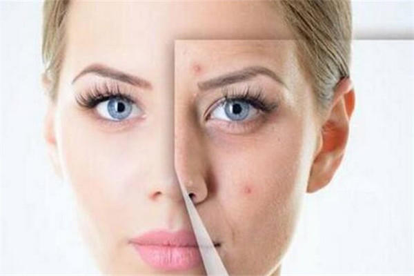 痘医生提醒您:容易长痘痘的五个操作，您占了几个？