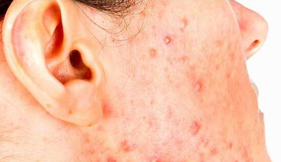 脸上长痘痘不管它会导致什么后果？你想知道吗？