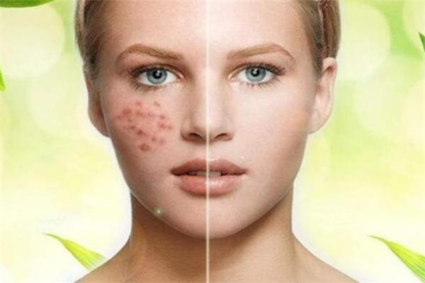 过敏性肌肤如何快速祛除痘痘