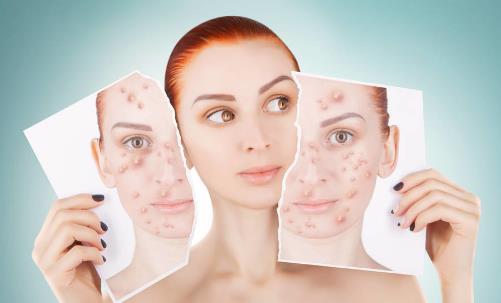 痘医生专业祛痘分析长痘痘是什么原因引起的