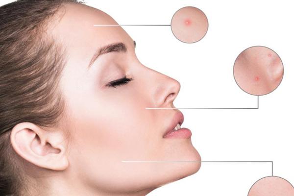  祛痘护肤也是有讲究的，不做无用功