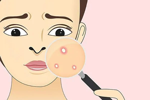 生活中如何避免痘痘？