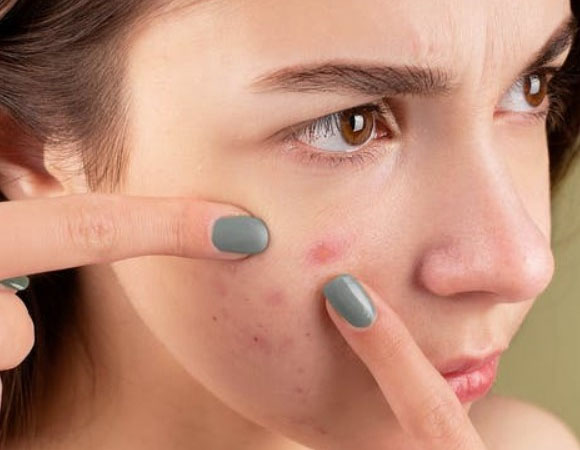 痘医生祛痘常识