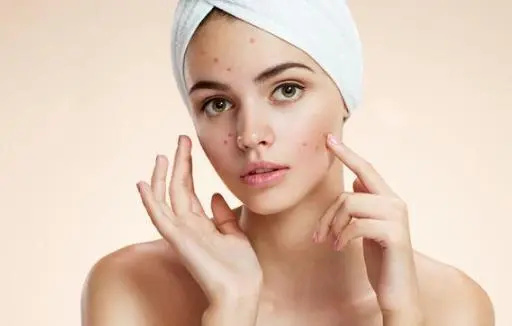 痘医生祛痘常识