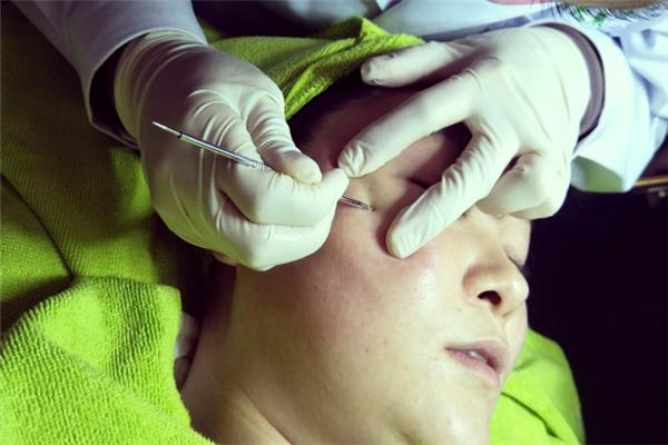 痘医生祛痘护肤 最全的祛痘方法集合