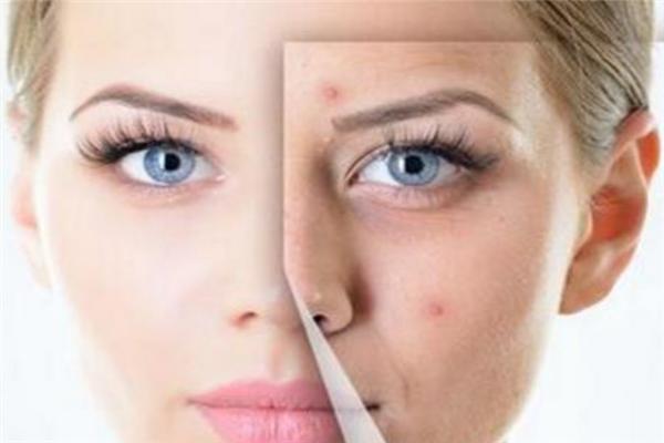 痘痘反复祛不掉？痘医生专业祛痘还你无暇肌