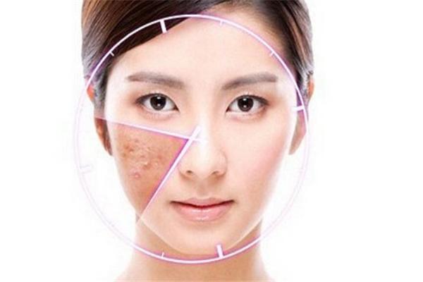 痘医生科普压力大满脸痘？这些祛痘误区不要犯