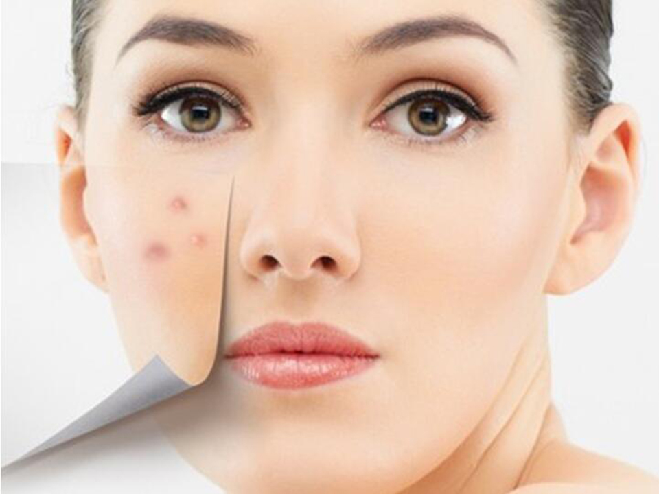 脸上长痘是什么原因造成的-祛痘常识