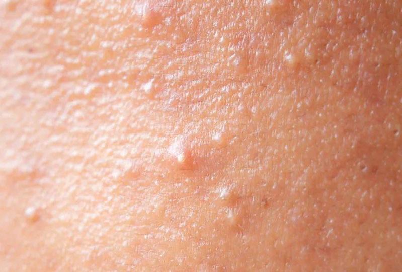 痘医生祛痘知识