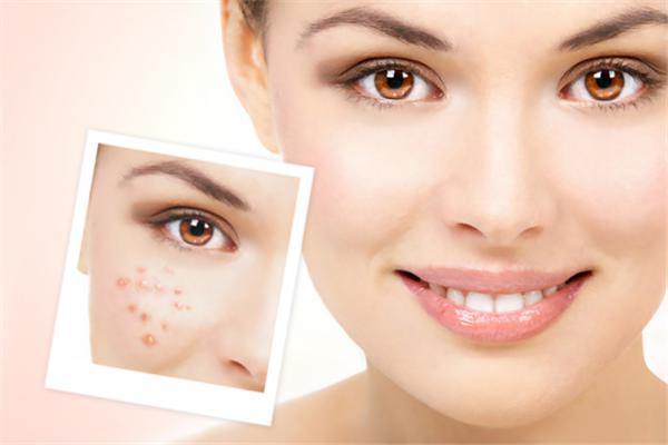 脸上长痘痘的原因