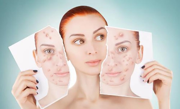 痘医生教你正确祛斑？