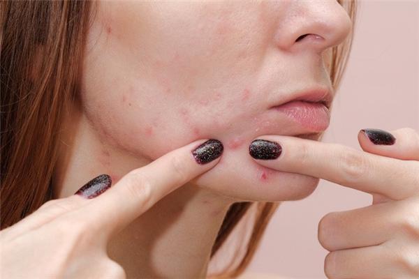 每天5分钟祛痘指南